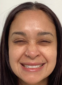 Houston Wellness & Aesthetics|Before and After Gallery