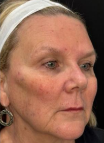 Facial-Volume-Restoration-after-2 Houston Wellness & Aesthetics|Before and After Gallery