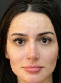 Facial-Volume-Restoration-after-3 Houston Wellness & Aesthetics|Before and After Gallery