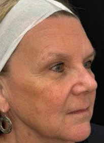 Facial-Volume-Restoration-before-2 Houston Wellness & Aesthetics|Before and After Gallery