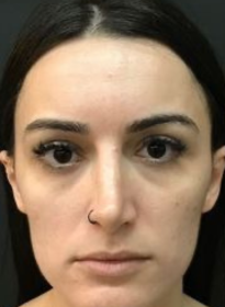 Facial-Volume-Restoration-before-3 Houston Wellness & Aesthetics|Before and After Gallery