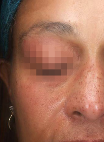 Icon-Elite-iQ-after-2 Houston Wellness & Aesthetics|Before and After Gallery