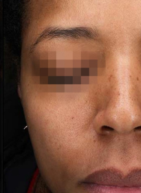 Icon-Elite-iQ-after-3 Houston Wellness & Aesthetics|Before and After Gallery