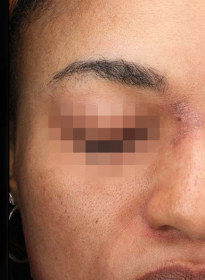 Icon-Elite-iQ-after Houston Wellness & Aesthetics|Before and After Gallery