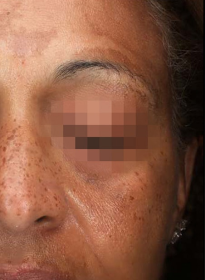 Icon-Elite-iQ-before-2 Houston Wellness & Aesthetics|Before and After Gallery