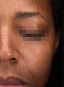 Icon-Elite-iQ-before-3 Houston Wellness & Aesthetics|Before and After Gallery