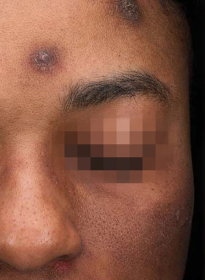 Icon-Elite-iQ-before Houston Wellness & Aesthetics|Before and After Gallery