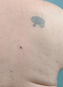 Laser-Hair-Removal-after-10 Houston Wellness & Aesthetics|Before and After Gallery