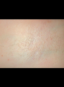 Laser-Hair-Removal-after-11 Houston Wellness & Aesthetics|Before and After Gallery