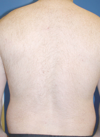 Laser-Hair-Removal-after-12 Houston Wellness & Aesthetics|Before and After Gallery
