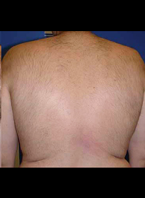 Laser-Hair-Removal-after-2 Houston Wellness & Aesthetics|Before and After Gallery