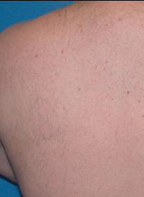 Laser-Hair-Removal-after-3 Houston Wellness & Aesthetics|Before and After Gallery