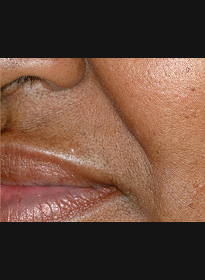 Laser-Hair-Removal-after-4 Houston Wellness & Aesthetics|Before and After Gallery