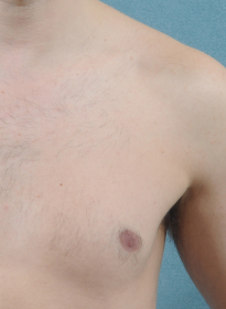 Laser-Hair-Removal-after-5 Houston Wellness & Aesthetics|Before and After Gallery