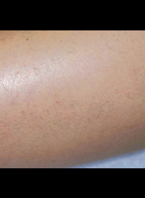 Laser-Hair-Removal-after-6 Houston Wellness & Aesthetics|Before and After Gallery
