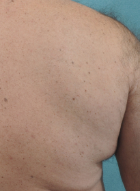 Laser-Hair-Removal-after-7 Houston Wellness & Aesthetics|Before and After Gallery