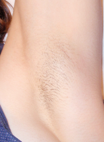 Laser-Hair-Removal-after-8 Houston Wellness & Aesthetics|Before and After Gallery