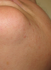 Laser-Hair-Removal-after-9 Houston Wellness & Aesthetics|Before and After Gallery