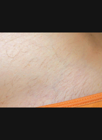 Laser-Hair-Removal-after Houston Wellness & Aesthetics|Before and After Gallery