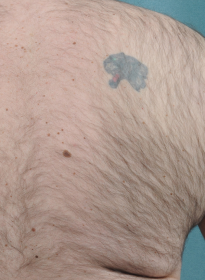 Laser-Hair-Removal-before-10 Houston Wellness & Aesthetics|Before and After Gallery