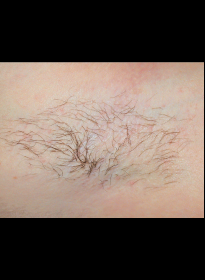 Laser-Hair-Removal-before-11 Houston Wellness & Aesthetics|Before and After Gallery