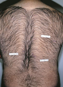 Laser-Hair-Removal-before-12 Houston Wellness & Aesthetics|Before and After Gallery