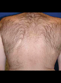Laser-Hair-Removal-before-2 Houston Wellness & Aesthetics|Before and After Gallery