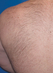 Laser-Hair-Removal-before-3 Houston Wellness & Aesthetics|Before and After Gallery