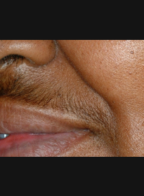 Laser-Hair-Removal-before-4 Houston Wellness & Aesthetics|Before and After Gallery