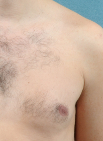 Laser-Hair-Removal-before-5 Houston Wellness & Aesthetics|Before and After Gallery