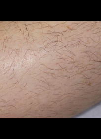 Laser-Hair-Removal-before-6 Houston Wellness & Aesthetics|Before and After Gallery