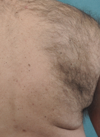 Laser-Hair-Removal-before-7 Houston Wellness & Aesthetics|Before and After Gallery