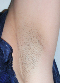 Laser-Hair-Removal-before-8 Houston Wellness & Aesthetics|Before and After Gallery