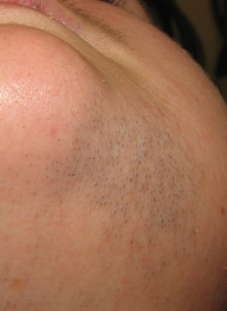 Laser-Hair-Removal-before-9 Houston Wellness & Aesthetics|Before and After Gallery