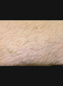 Laser-Hair-Removal-before Houston Wellness & Aesthetics|Before and After Gallery