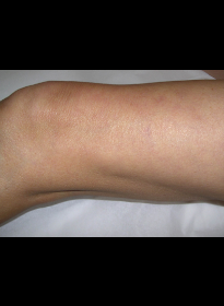Laser-Vein-Treatment-after-2 Houston Wellness & Aesthetics|Before and After Gallery