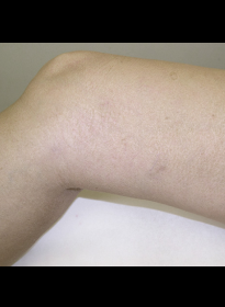 Laser-Vein-Treatment-after-3 Houston Wellness & Aesthetics|Before and After Gallery