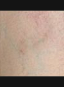 Laser-Vein-Treatment-after Houston Wellness & Aesthetics|Before and After Gallery