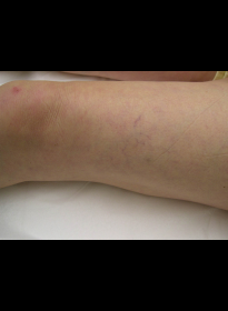 Laser-Vein-Treatment-before-2 Houston Wellness & Aesthetics|Before and After Gallery
