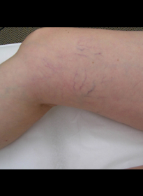 Laser-Vein-Treatment-before-3 Houston Wellness & Aesthetics|Before and After Gallery