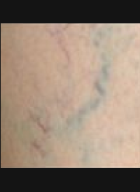 Laser-Vein-Treatment-before Houston Wellness & Aesthetics|Before and After Gallery