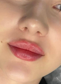 Lip-Enhancement-after-2 Houston Wellness & Aesthetics|Before and After Gallery