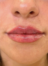 Lip-Enhancement-after-3 Houston Wellness & Aesthetics|Before and After Gallery