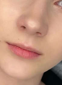 Lip-Enhancement-before-2 Houston Wellness & Aesthetics|Before and After Gallery