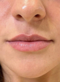 Lip-Enhancement-before-3 Houston Wellness & Aesthetics|Before and After Gallery
