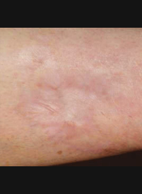 Scar-Removal-after-2 Houston Wellness & Aesthetics|Before and After Gallery