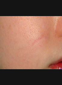 Scar-Removal-after-3 Houston Wellness & Aesthetics|Before and After Gallery