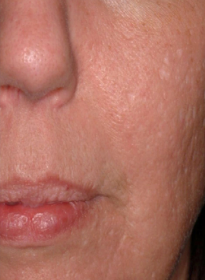 Scar-Removal-after-4 Houston Wellness & Aesthetics|Before and After Gallery