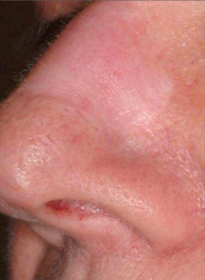 Scar-Removal-after-5 Houston Wellness & Aesthetics|Before and After Gallery