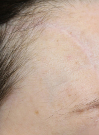 Scar-Removal-after Houston Wellness & Aesthetics|Before and After Gallery
